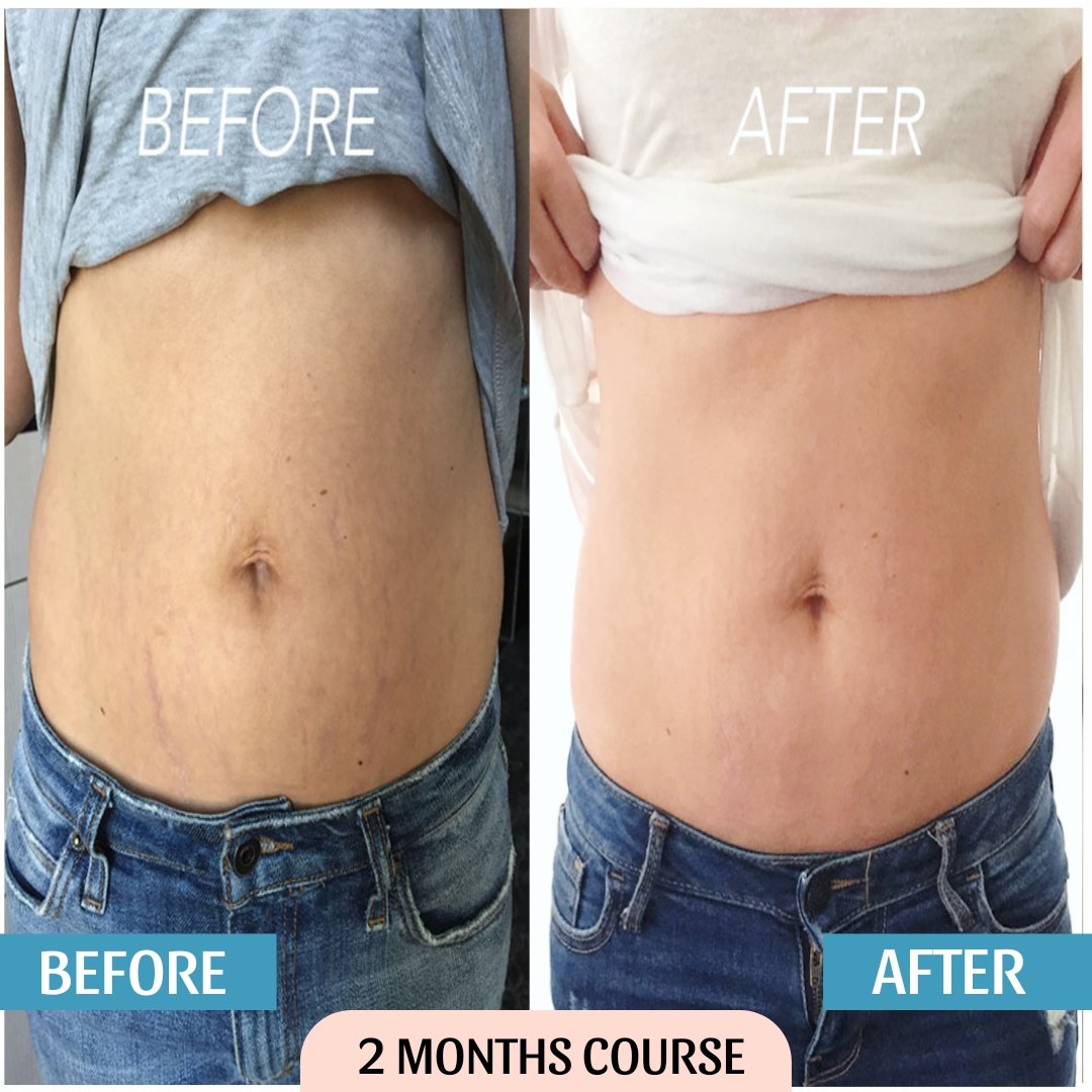 Stretch Mark Cream Result Before & After