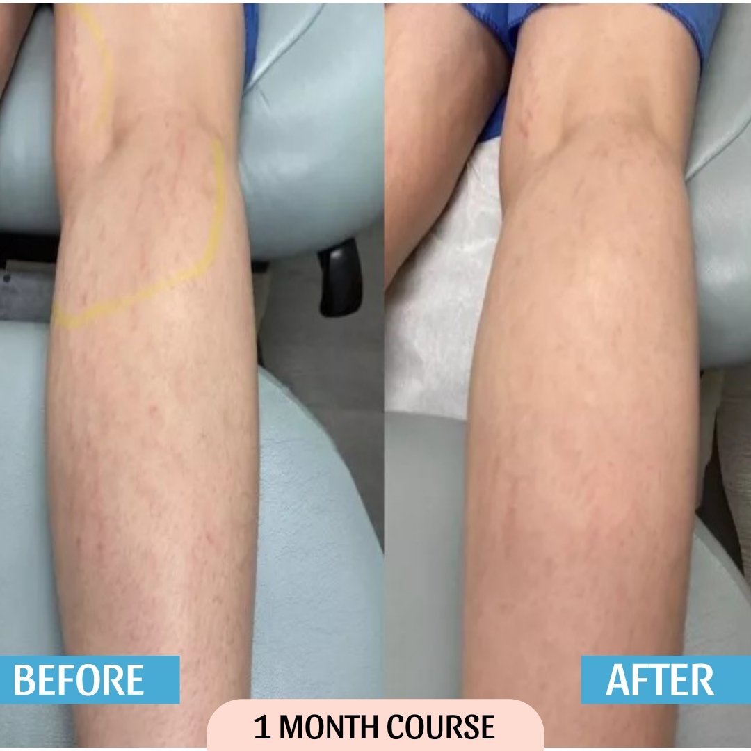 Stretch Mark Cream Result Before & After