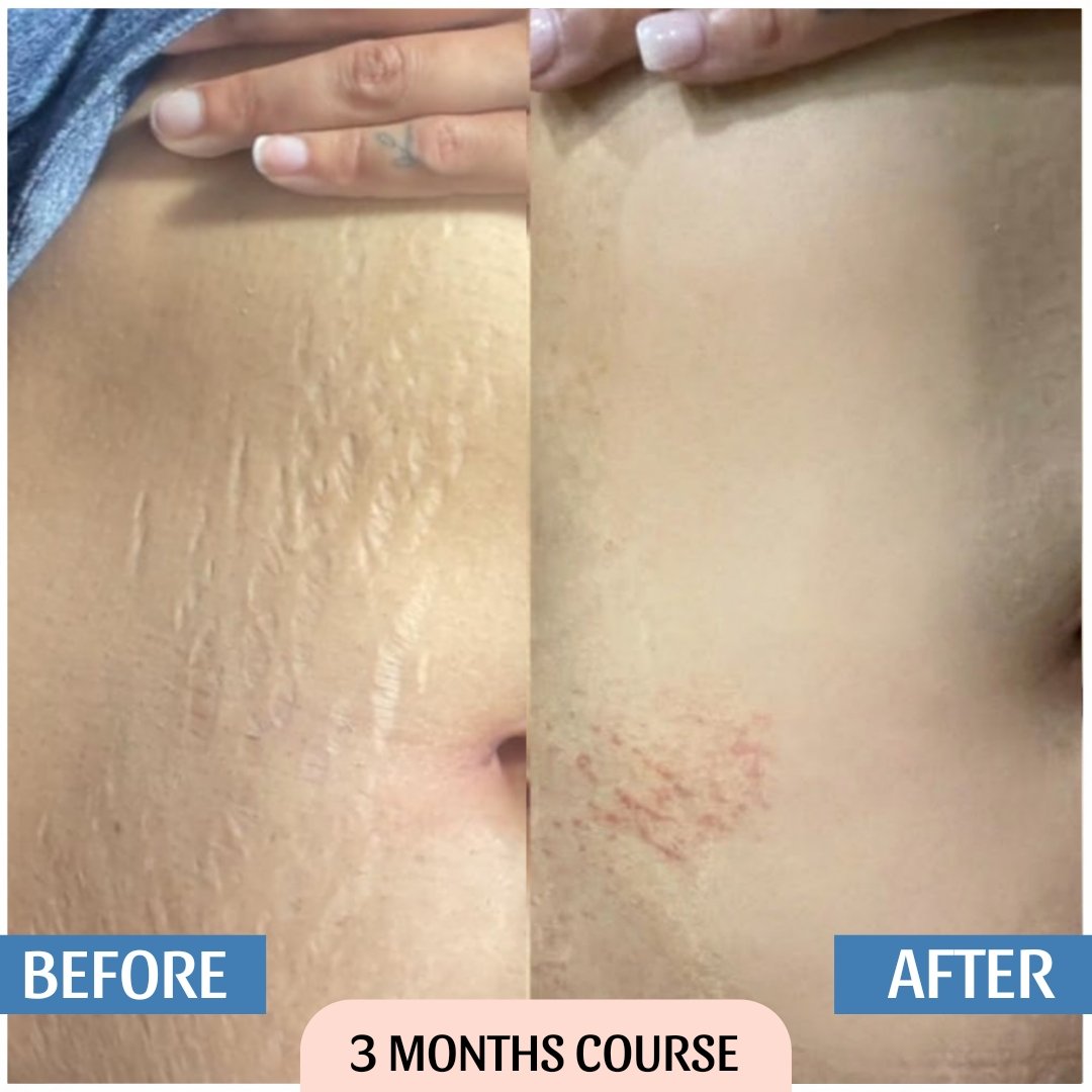 Stretch Mark Cream Result Before & After