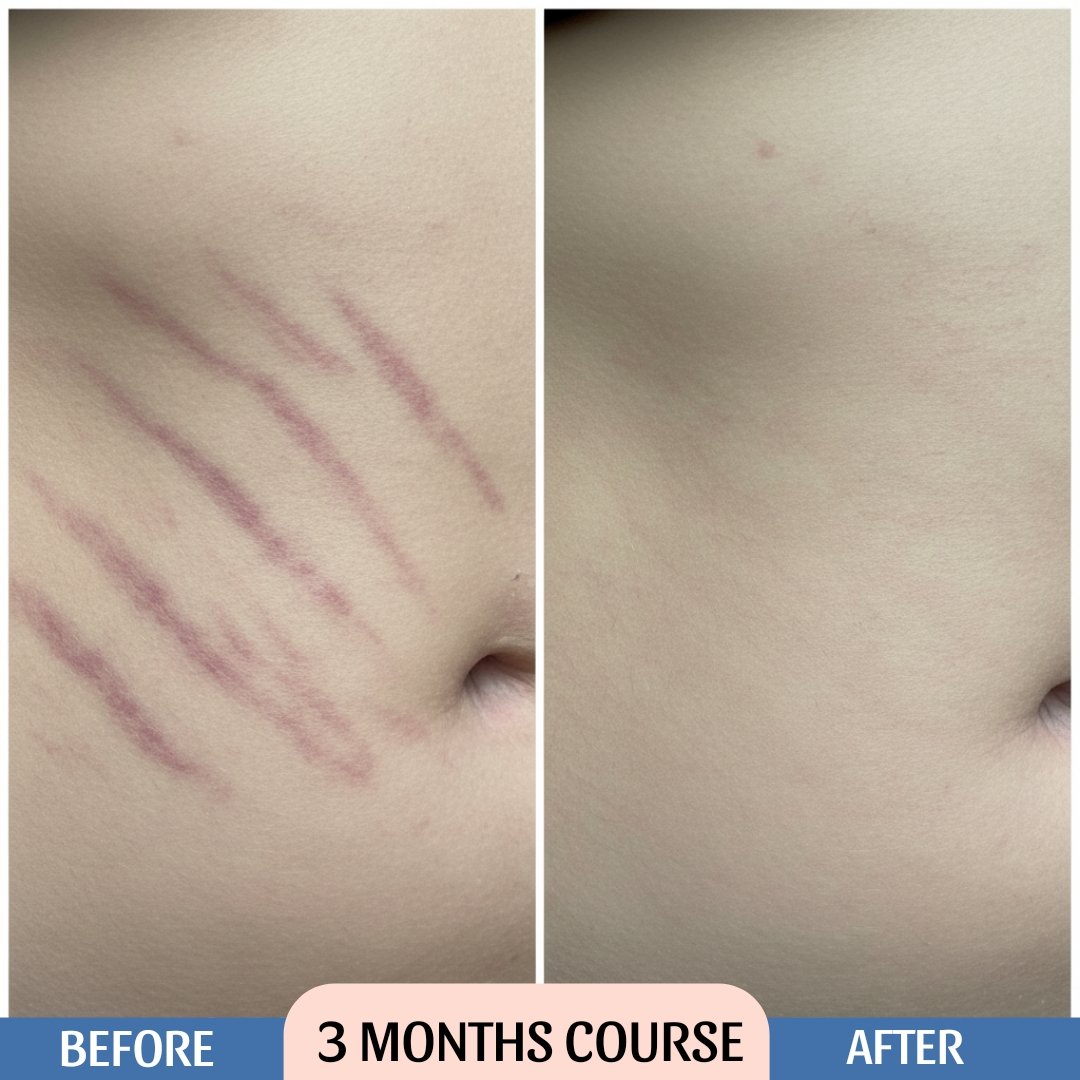 Stretch Mark Cream Result Before & After