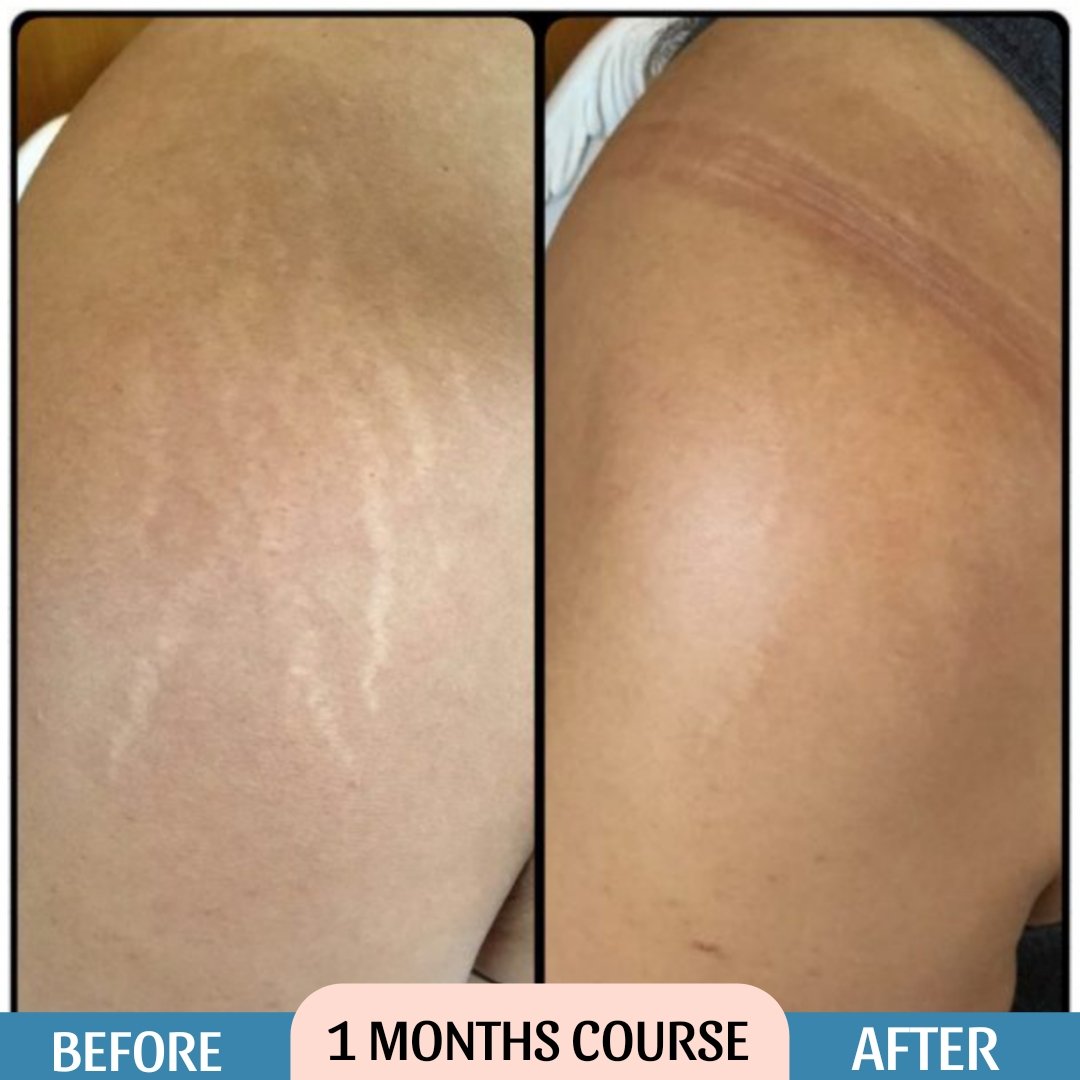 Stretch Mark Cream Result Before & After